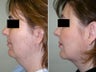 Submental and Neck Liposculpture