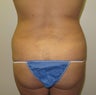 Bilateral Flank & Back Liposuction