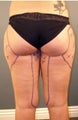 Tumescent Liposuction Under Local Anesthesia.