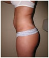 Liposulpture of abdomen, waist, flanks and inner thighs.