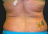 Lipo for back