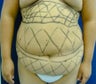 Liposculpture for stomach