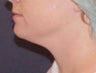 Neck lipo