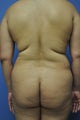 Liposuction of the hips