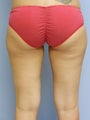 Laser Lipo on Outer Thighs
