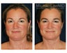 Chin Liposuction