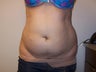 Liposuction