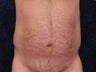 Liposuction to the waist and hips.