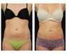 Liposuction