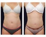 Liposuction