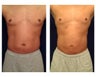 Liposuction