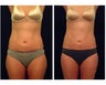 Liposuction