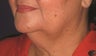 Liposculpting of neck, neck lift and facelift