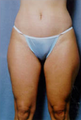 Suction Lipectormy of Inner and Outer thighs