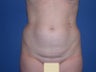 Abdominal Liposculpture