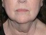 Liposculpture