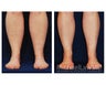 Liposuction