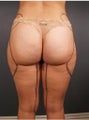 Tumescent Liposuction