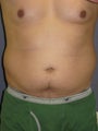 Liposuction Male