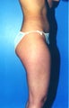 liposuction of thighs for women