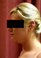 liposuction of neck & jaw line for women