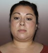 Lipocontouring of the neck