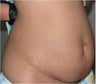 Liposculpturing