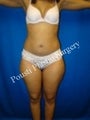 Liposuction