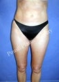 Liposuction
