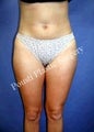 Liposuction