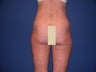 Thigh Liposculpture