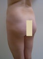 Buttock augmentation and liposculpture