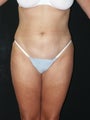 Liposuction