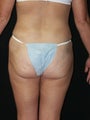 Liposuction