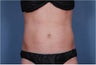 Liposonix