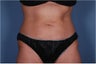 Liposonix to Abdomen