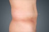 Liposonix