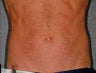 Liposonix