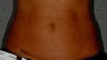 Liposonix