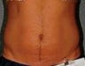 Liposonix