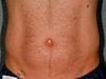 Liposonix