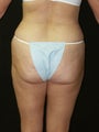 Liposuction