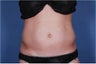 Liposonix
