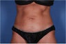 Liposonix to Abdomen