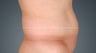Liposonix