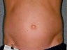 Liposonix