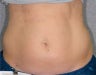 Liposonix