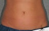 Liposonix