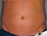 Liposonix