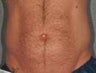 Liposonix